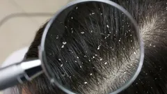 Zabudnite na drahé šampóny a chémiu: zbavte sa lupín pomocou ingrediencie, ktorú máte doma