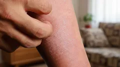 Mikroskopické monštrá nablízku: Kto sa skrýva pod pokožkou a ako ich spoznať