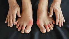Stále vás bolia kĺby na prstoch nôh? Odborníci vysvetľujú, ako sa bolesti navždy zbaviť